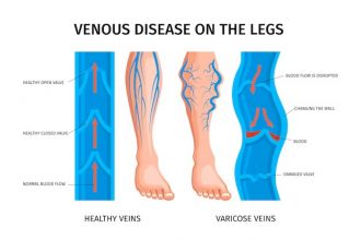 understanding-varicose-veins:-causes,-symptoms,-and-treatments