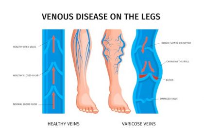 understanding-varicose-veins:-causes,-symptoms,-and-treatments